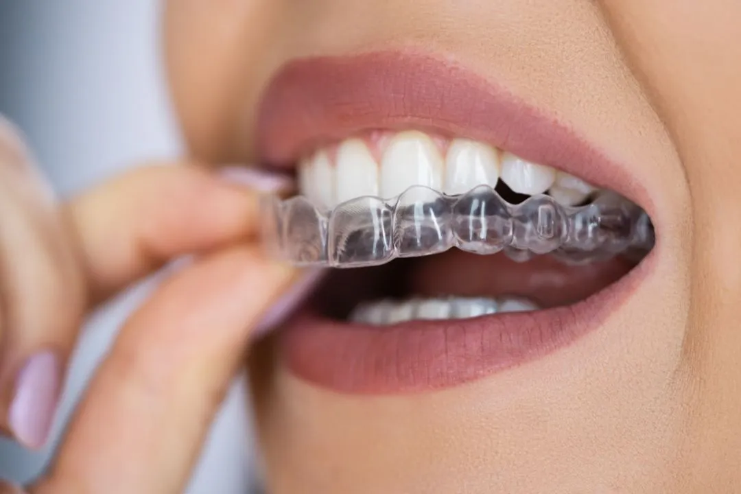 Invisalign / Clear Aligners