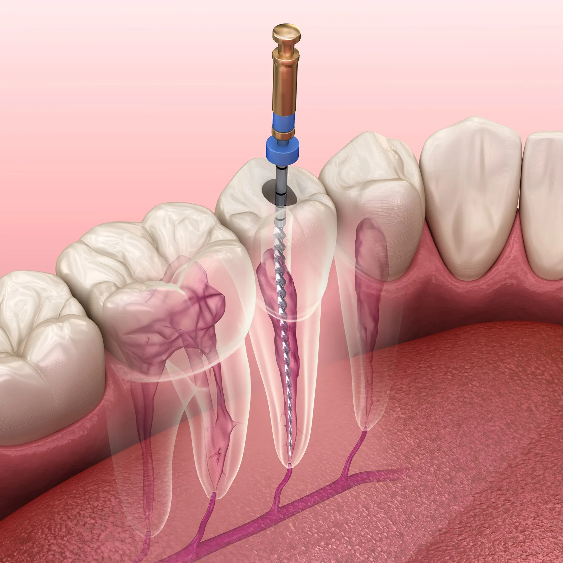 Apicoectomy