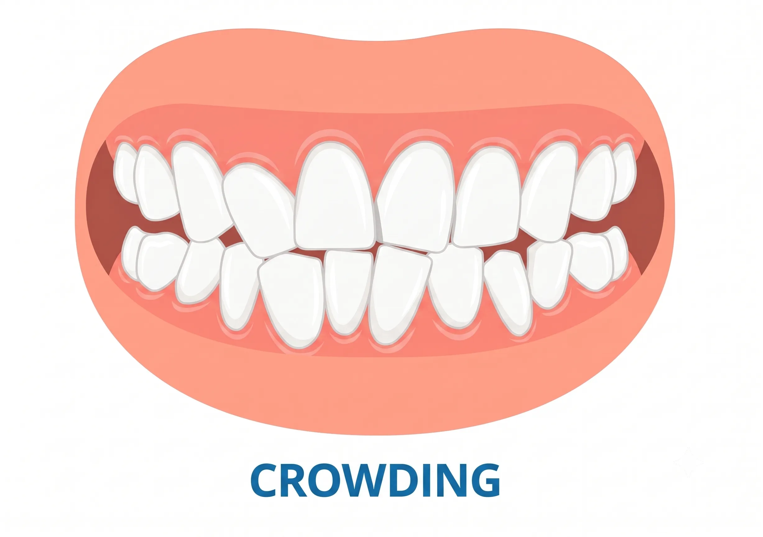 Crowded Teeth