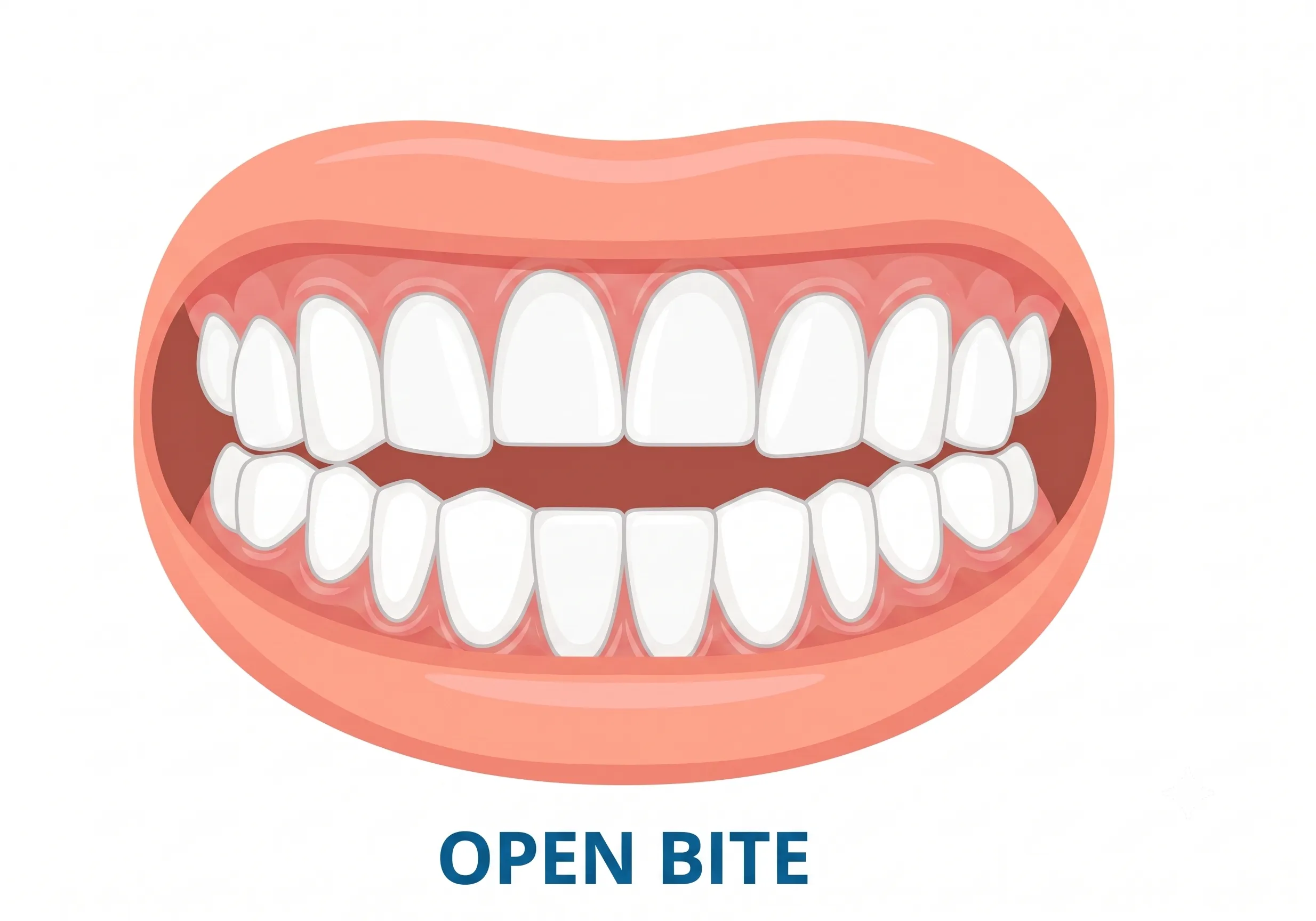 Open Bite